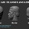 Hair_Transplant